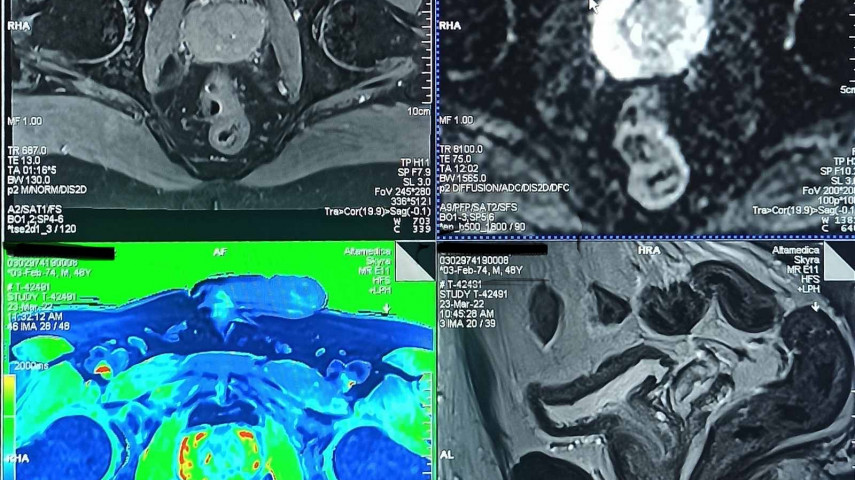 mp-MRI prostate!